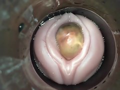 rụng trứng dính bởi kiêm cam supplicant